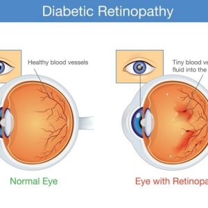 Segni, cause e trattamenti della retinopatia diabetica