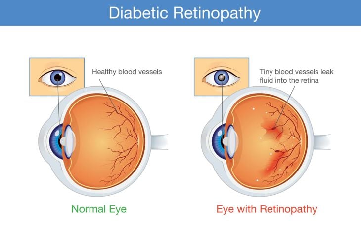 Segni, cause e trattamenti della retinopatia diabetica 1