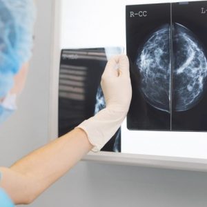 Domande frequenti sui noduli al seno Domande frequenti sui noduli al seno