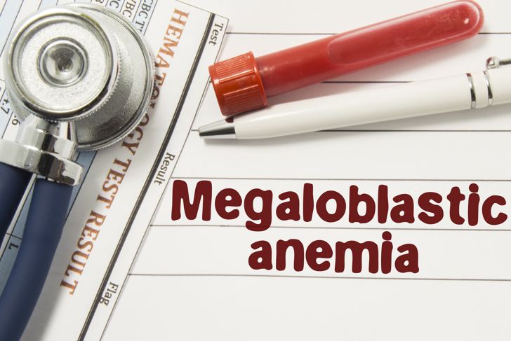 Cause, sintomi e trattamento dell'anemia macrocitica 3