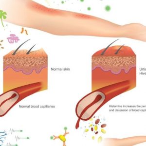 10 domande frequenti sull’orticaria acuta 10 domande frequenti sull’orticaria acuta