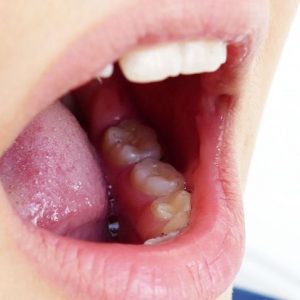 Cosa sono i calcoli tonsillari?