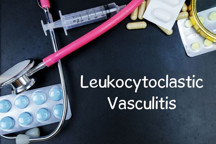Sintomi e rischi della vasculite leucocitoclastica 1