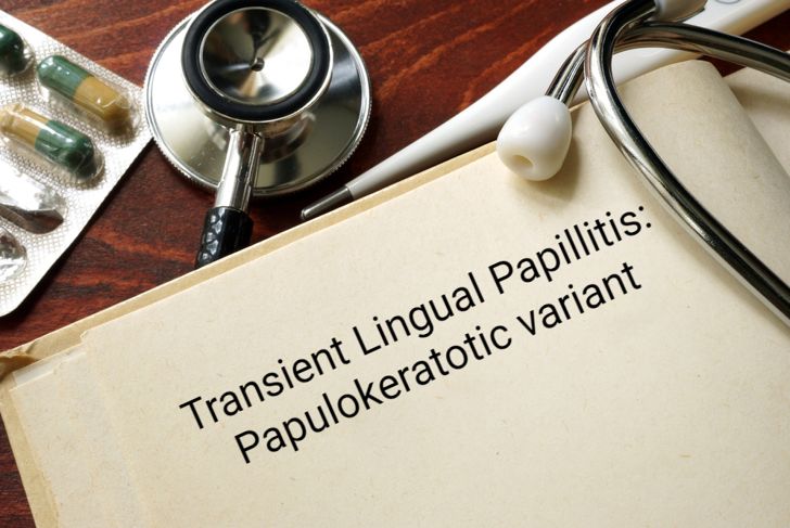 Protuberanze sulla lingua: Papillite linguale transitoria 7