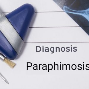 Sintomi e trattamento della parafimosi