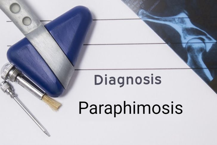 Sintomi e trattamento della parafimosi 1