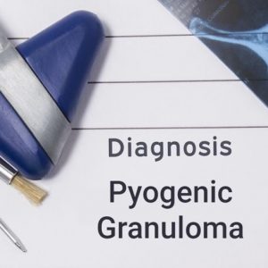 Granuloma piogenico: Un tumore vascolare comune