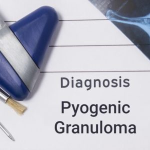 Granuloma piogenico: Un tumore vascolare comune Granuloma piogenico: Un tumore vascolare comune