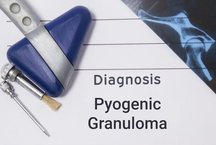 Granuloma piogenico: Un tumore vascolare comune 1