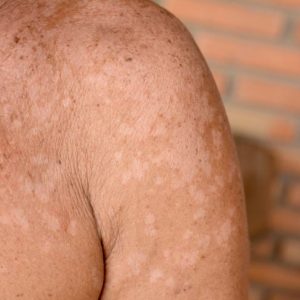 Sintomi e trattamenti della pitiriasi versicolor Sintomi e trattamenti della pitiriasi versicolor