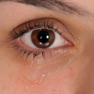 Dotti lacrimali bloccati: Cause e trattamenti