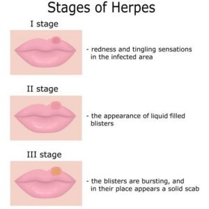 Herpes Simplex: la malattia nascosta