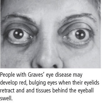 Malattia oculare di Graves (oftalmopatia di Graves) 1