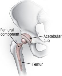 Frattura dell'anca 1