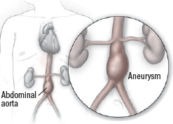Aneurisma dell'aorta addominale 1