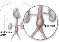 Aneurisma dell’aorta addominale Aneurisma dell’aorta addominale