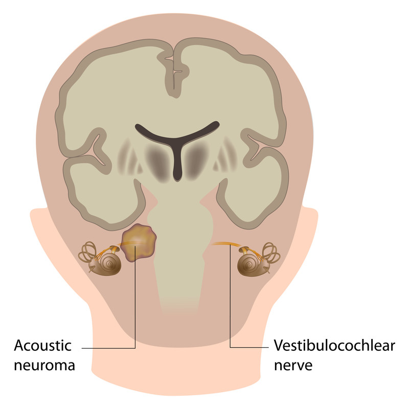 Neuroma acustico 1