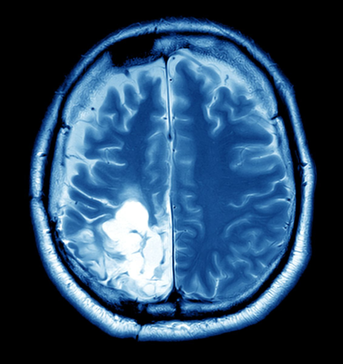 Panoramica sul tumore cerebrale 1