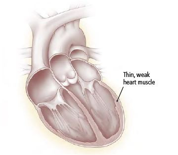 Cardiomiopatia 4 Cardiomiopatia 3