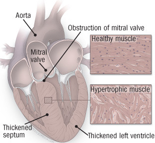 Cardiomiopatia 5