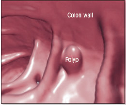 Polipi del colon 1