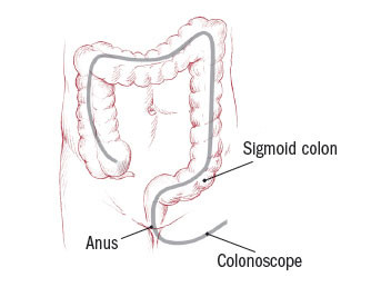 Polipi del colon 3