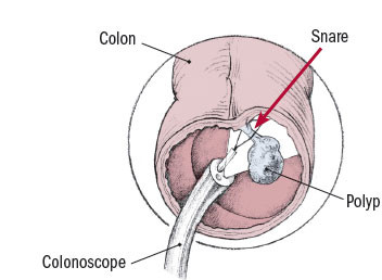 Polipi del colon 5