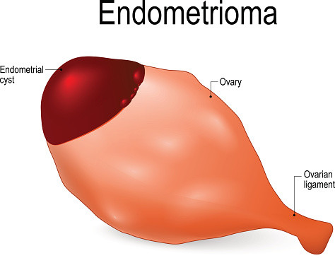 Endometriosi 1
