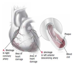 Infarto cardiaco (infarto del miocardio) 1