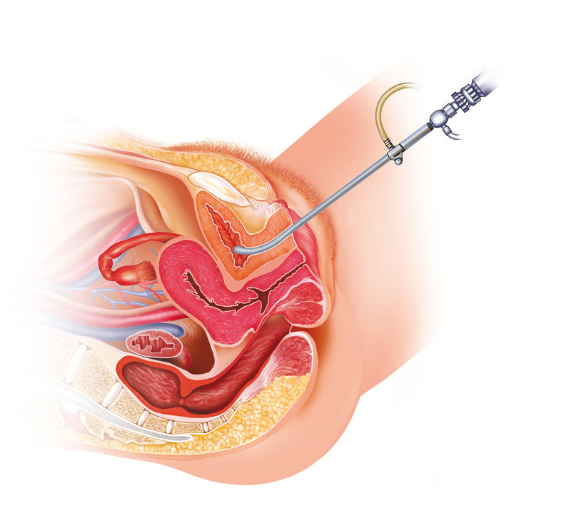 Ematuria Ematuria