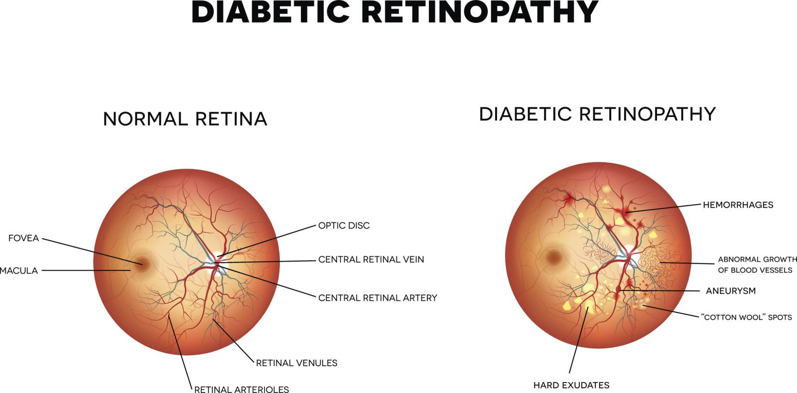 Retinopatia 4 Retinopatia 3
