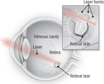 Retinopatia 6 Retinopatia 5