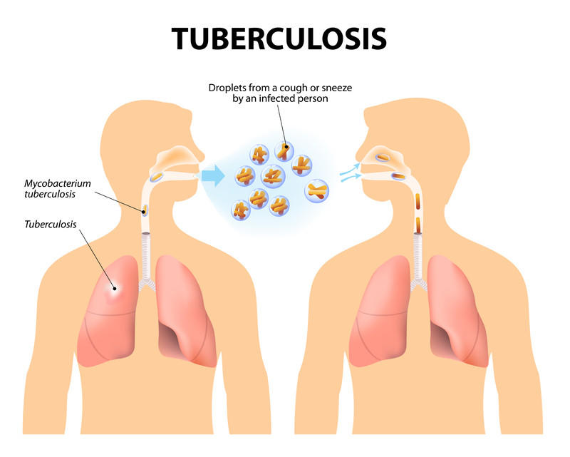 Tubercolosi 1