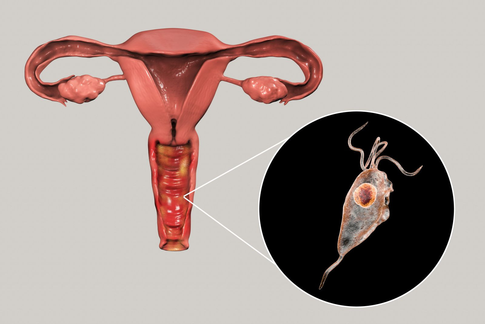 Vaginite 6 Vaginite 5