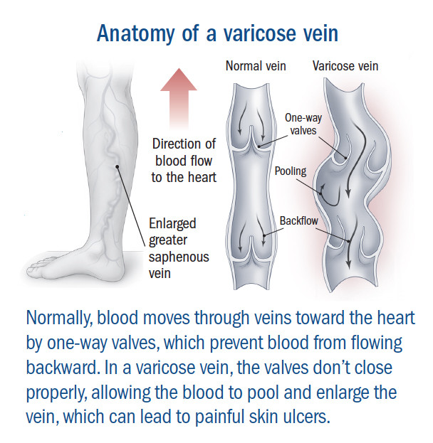 Vene varicose