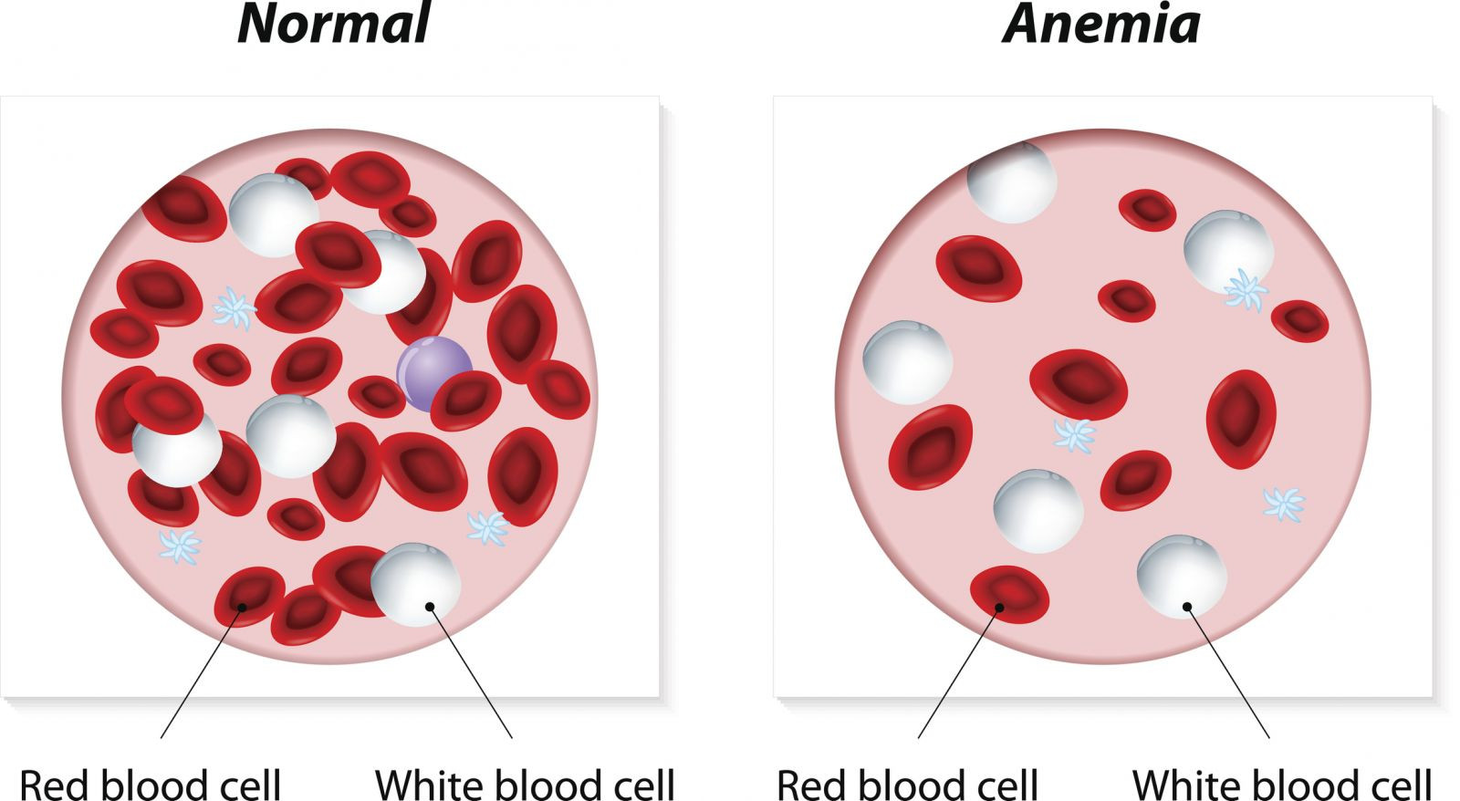 Panoramica sull'anemia 1