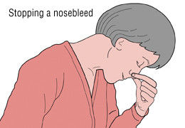 Emorragia nasale (epistassi) 3