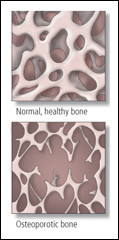 Osteoporosi