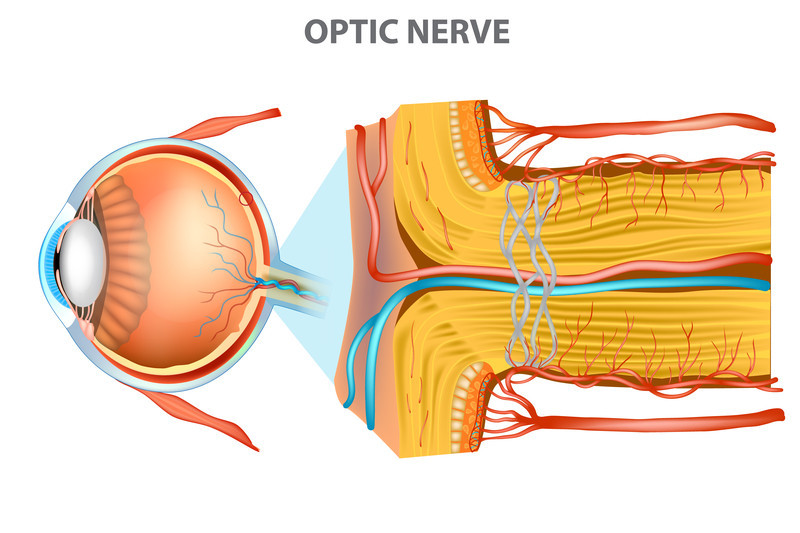 Gonfiore del nervo ottico (papilledema) Gonfiore del nervo ottico (papilledema)