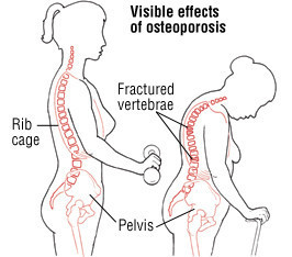 Osteoporosi 4 Osteoporosi 3