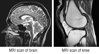 Risonanza magnetica (MRI)