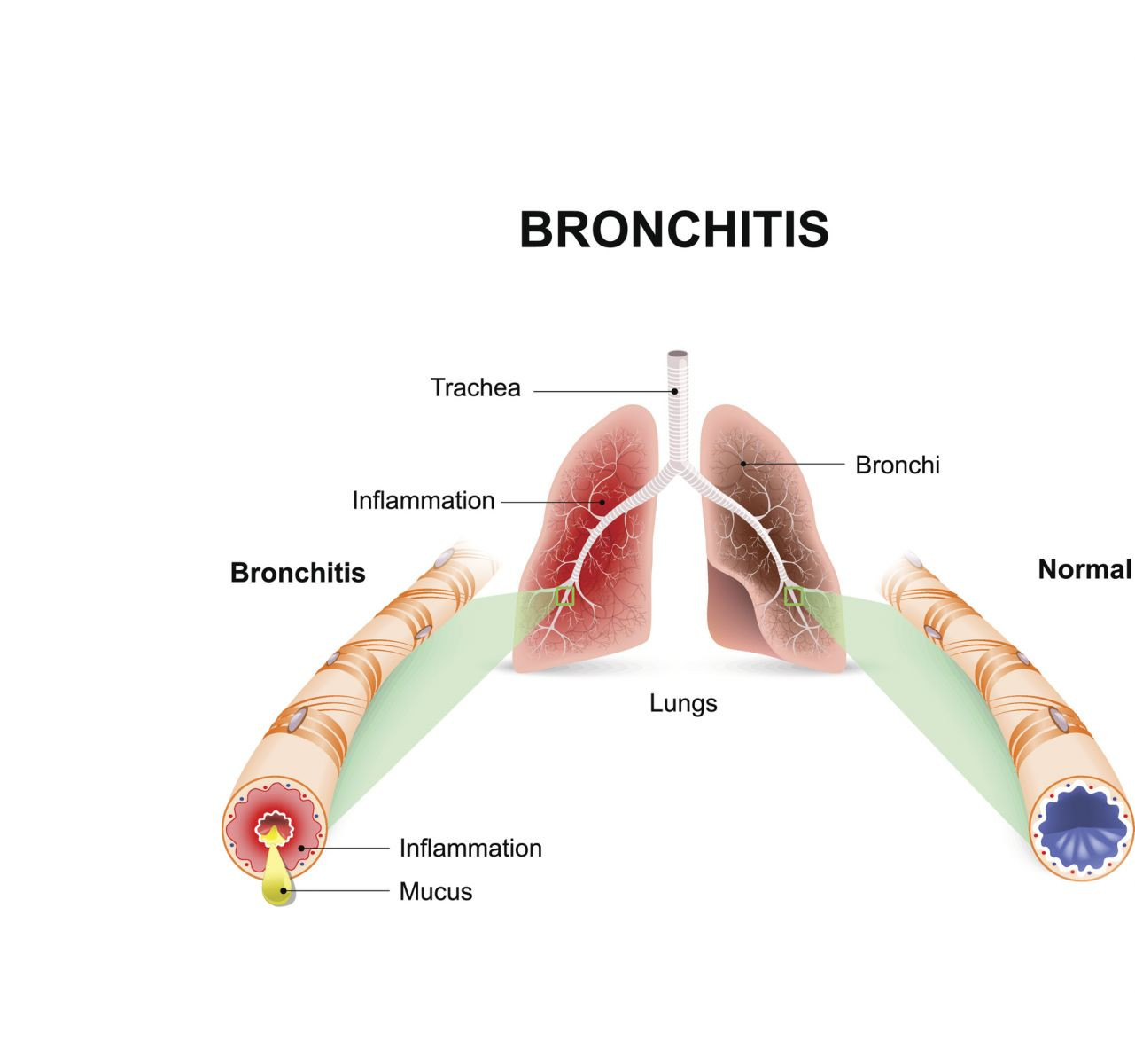 Bronchite acuta