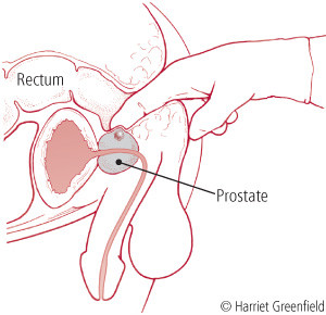 Prostatite acuta 3
