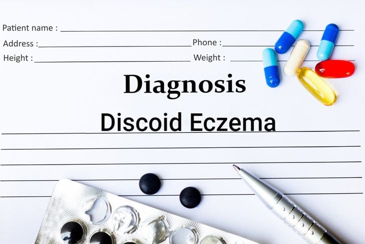 Cause, sintomi e trattamenti dell'eczema discoide 5