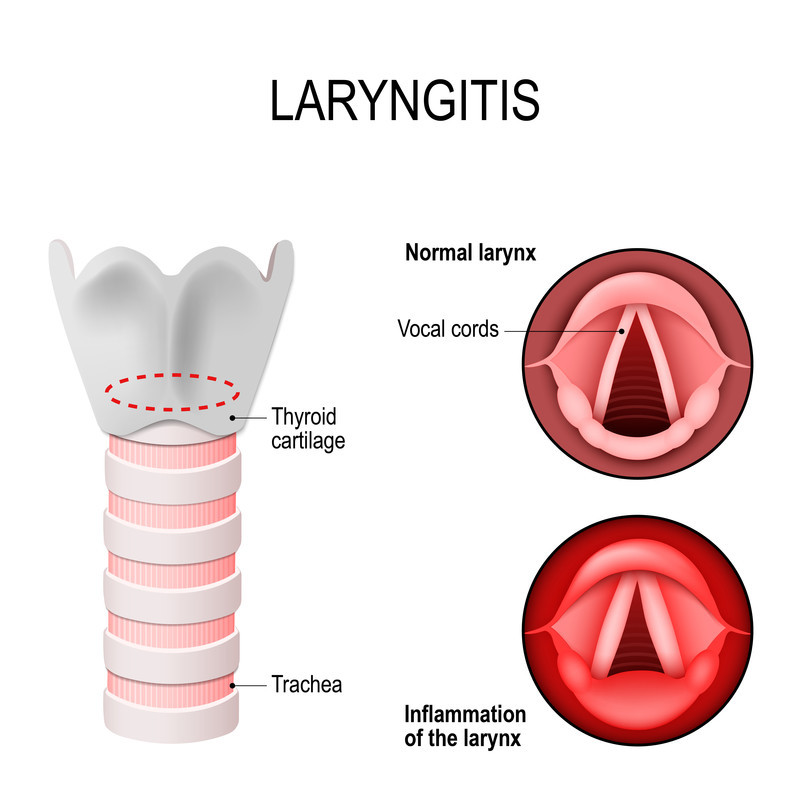 Laringite Laringite