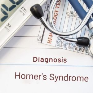 Che cos’è la sindrome di Horner?