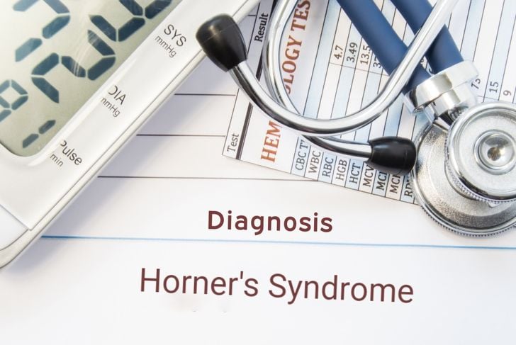 Che cos'è la sindrome di Horner? 1
