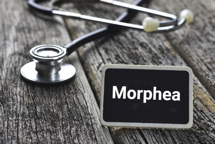 Segni, cause e trattamenti della morfea 7