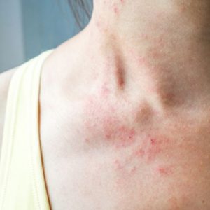 Non vi sentite bene? Forse è neutropenia Non vi sentite bene? Forse è neutropenia