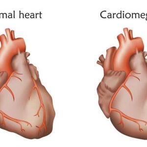 Che cos’è un cuore ingrossato? Che cos’è un cuore ingrossato?